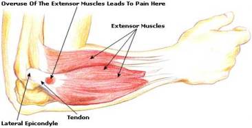 Corticosteroid injection for tennis elbow